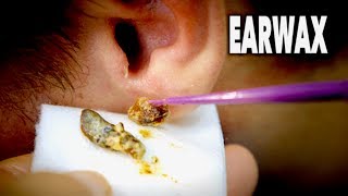 THE BEST EARWAX REMOVAL EVER!  (and most gross)  | Dr. Paul