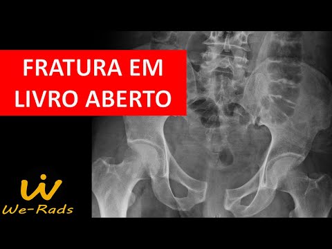 Open Book Fracture in Tomography