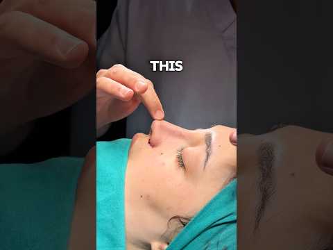 The Truth About Thick Skin Rhinoplasty #thickskin #rhinoplasty