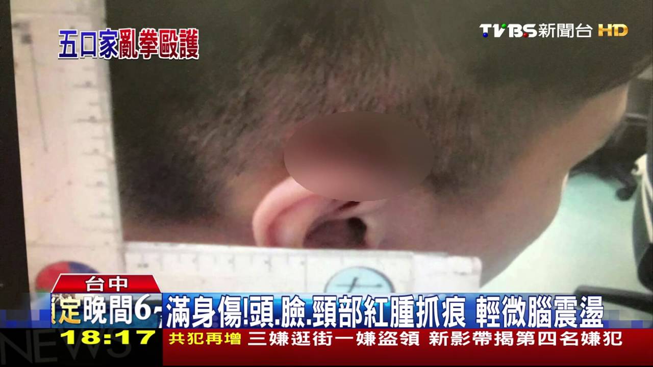 5個打1個！急診室護理師　遭病患家屬圍毆