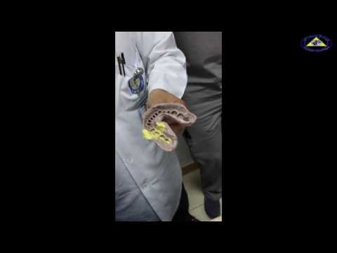 soft tissue management and impression taking - Dr.Rohit Fernandez