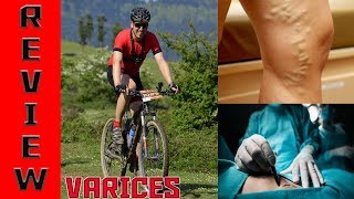 VARICES, MI INTERVENCIÓN 🚴🏻‍♂️