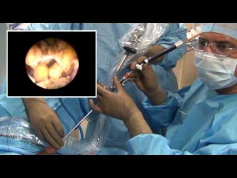 Transurethral Rigid Ureteroscopy