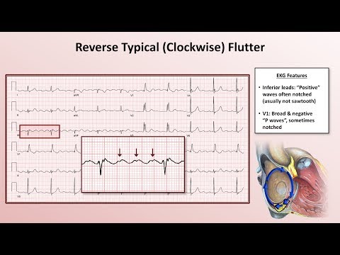 Advanced EKGs - The Subtypes of Atrial Flutter (typical vs. reverse typical vs. atypical)