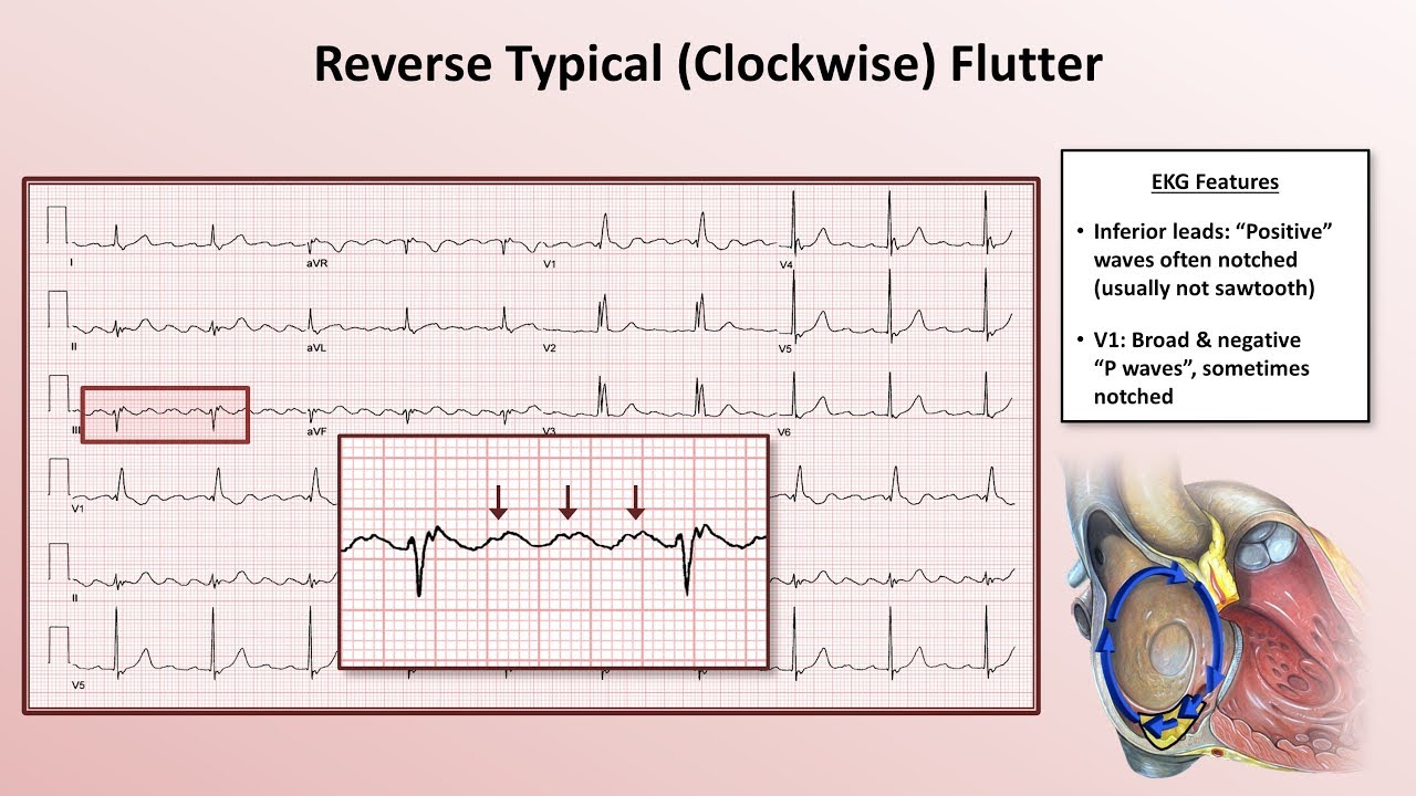 Advanced EKGs - The Subtypes of Atrial Flutter (typical vs. reverse typical vs. atypical)