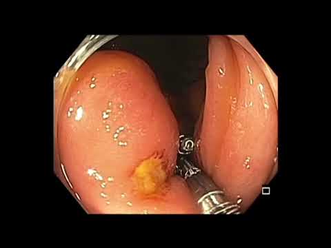 Colonoscopy: Cecum LST-G Challenging Cut - Part 2 (Clip Closure)