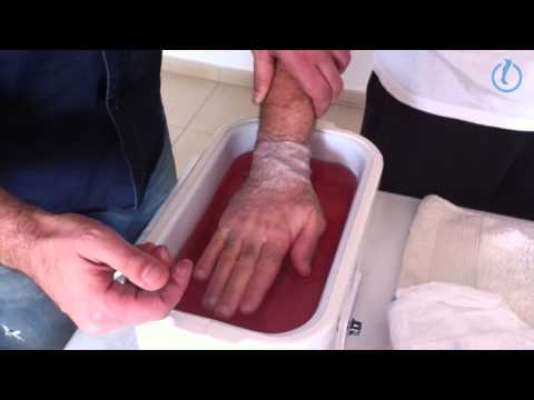 Hand-wrist pain relieved with paraffin in physiotherapy.