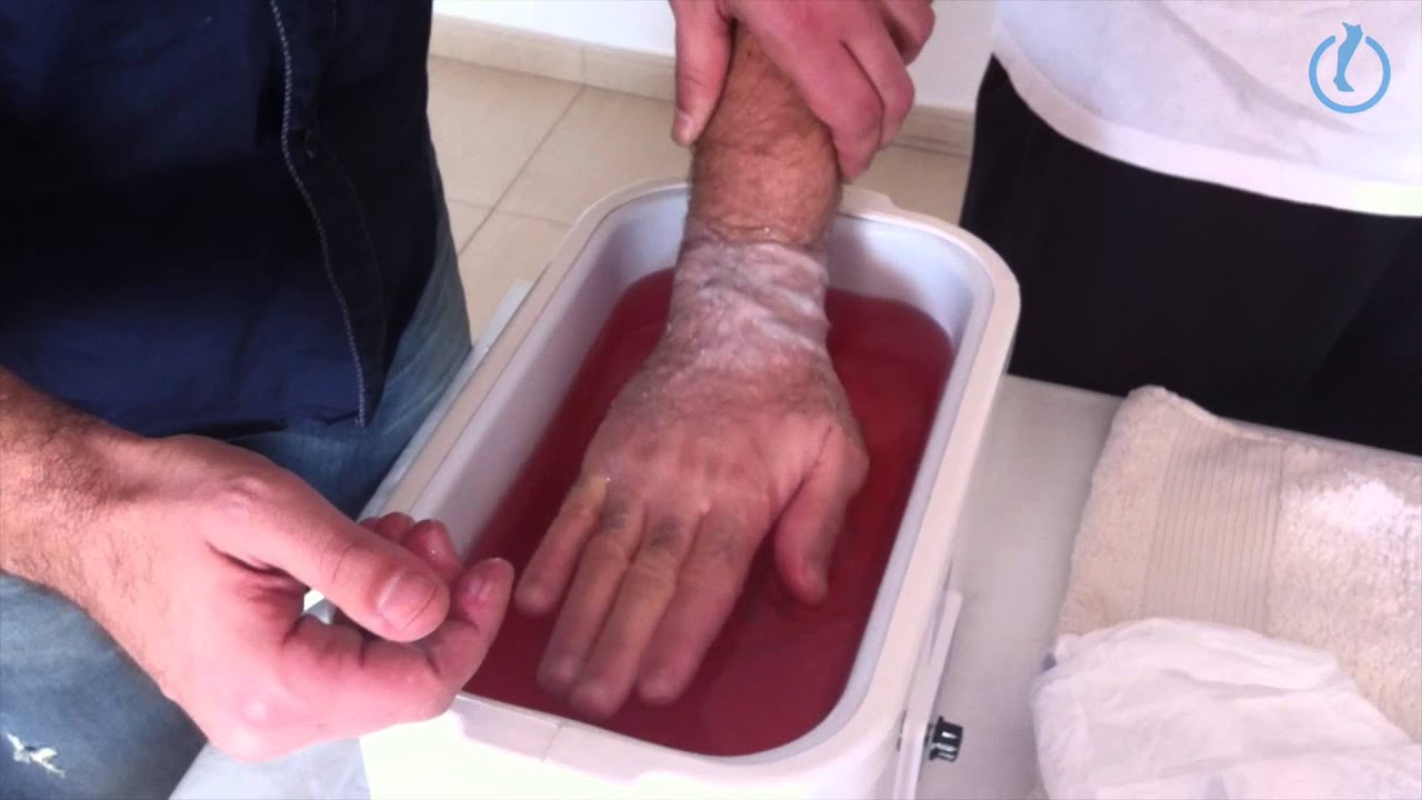 Dolor de mano-muñeca aliviado con parafina en fisioterapia.