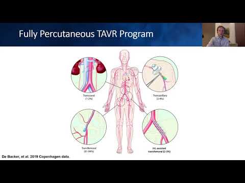 TAVR: Alternative Access Approaches and Techniques
