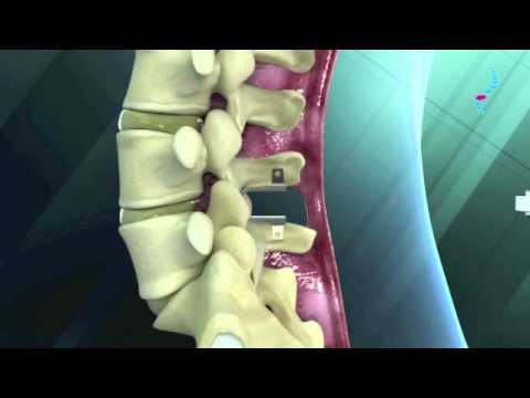 Dynamische Stabilisierung mit LeU und Pfliff