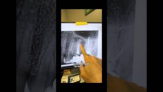 Does MTA extrusion cause endodontic failure?