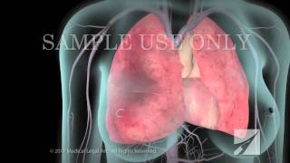 Deep Vein Thrombosis (DVT) and Pulmonary Embolism (PE)