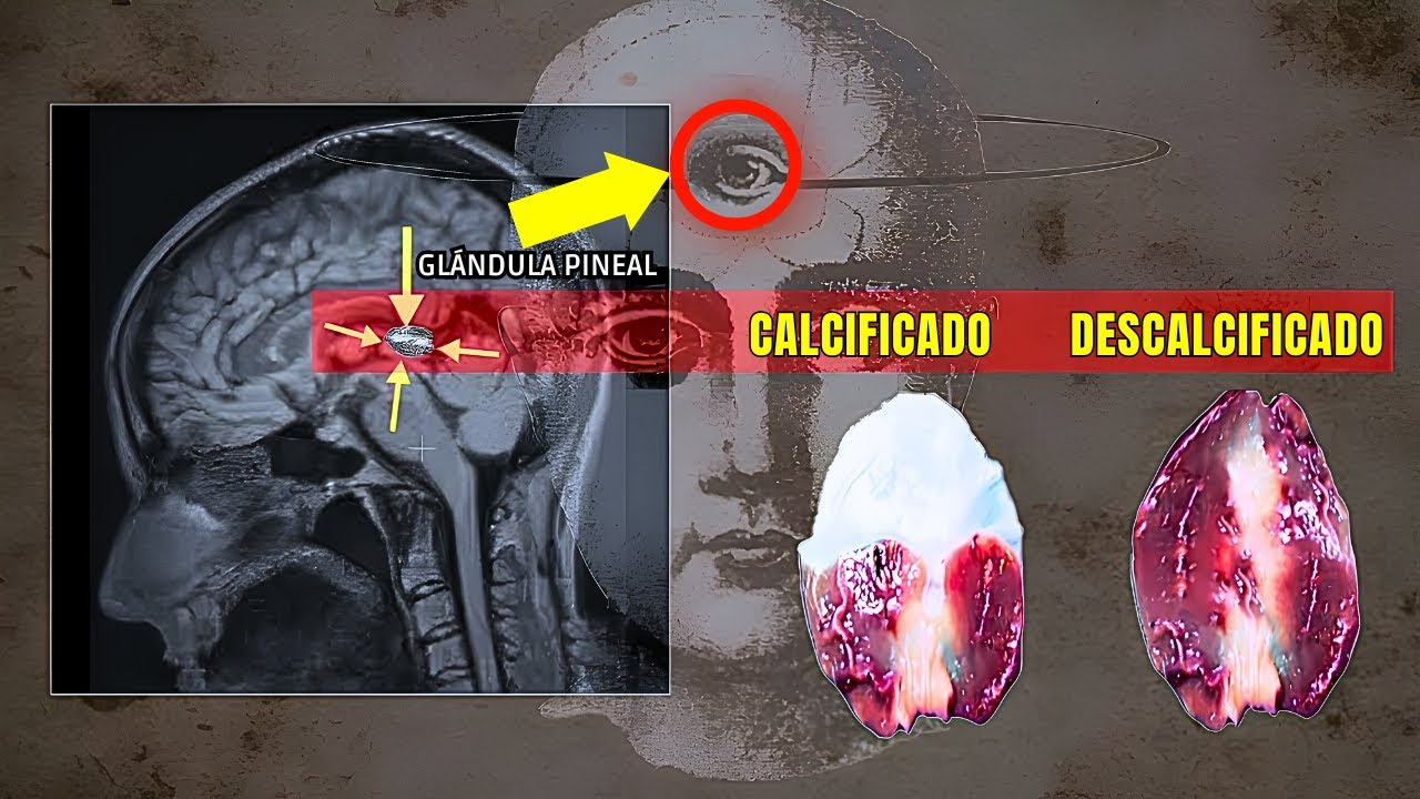 ¡Por fin descalcifiqué mi glándula pineal! Así es cómo...