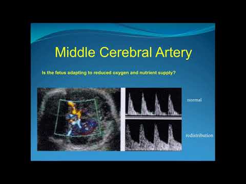 Obstetric Doppler Part 2