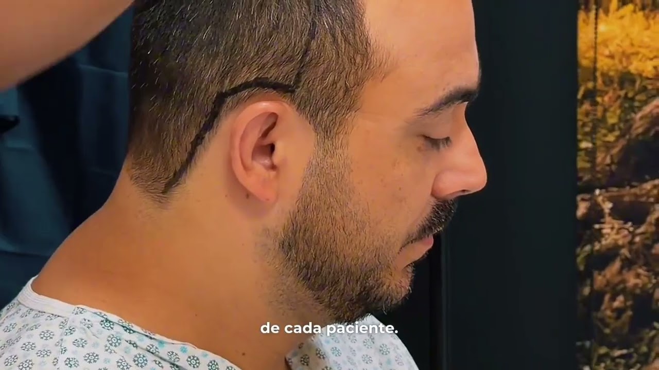 Transplante Capilar FUE em Goiânia — Técnica MAX FUE-BR | Dr. Gabriel Braga