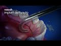 Waterpik™ Implant Denture Tip