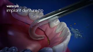 Waterpik Implant Denture Tip