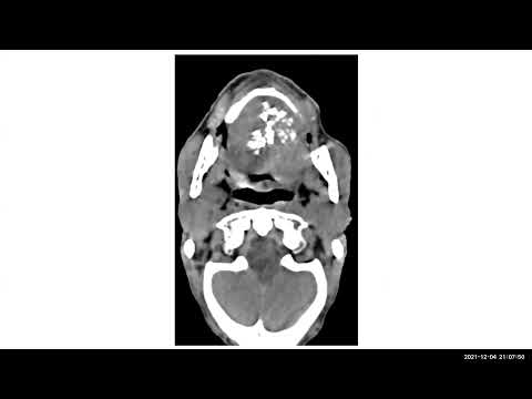 TEAM FRCR 2B Viva Practice Session (CHEST Module). 4th Dec, 2021