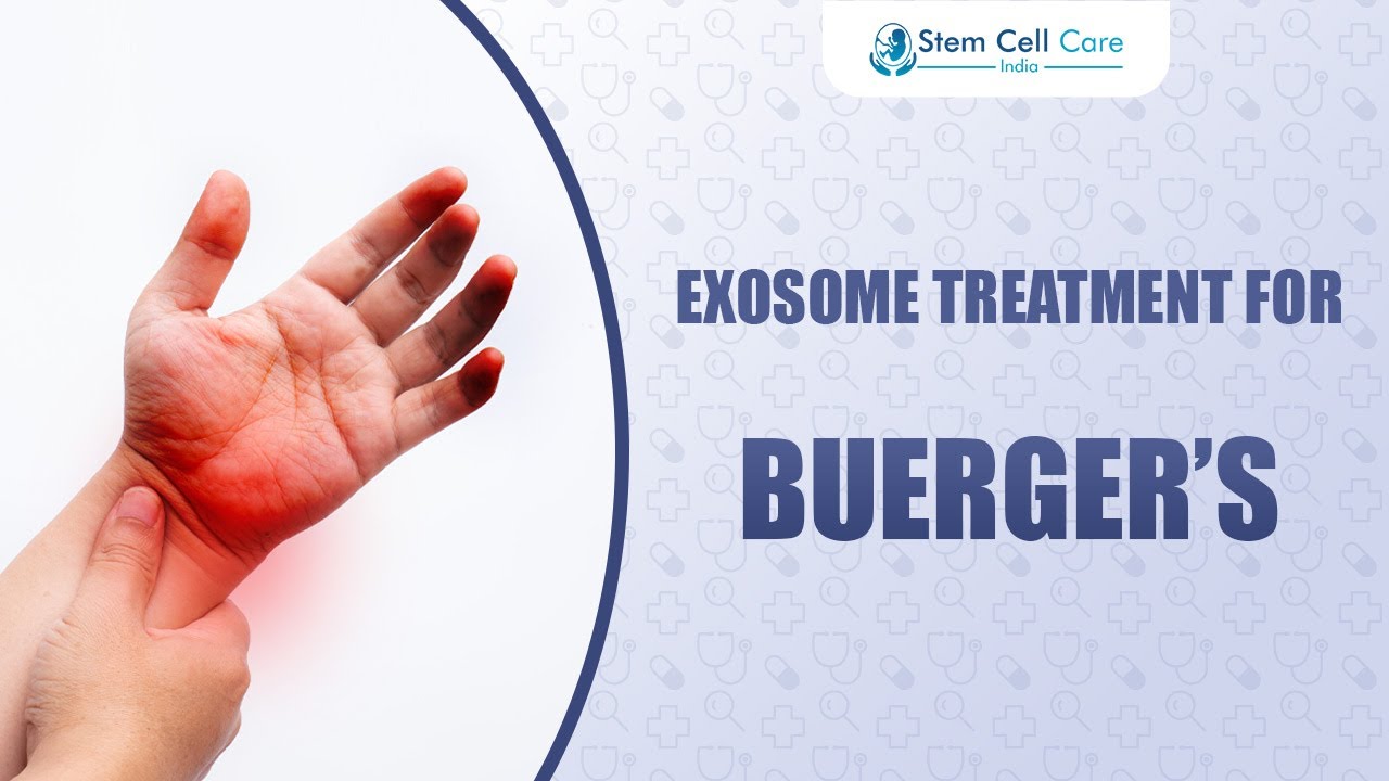 Exosome Therapy for Buerger’s Disease | Healing Blood Vessels