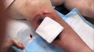 Hematoma Removal!  Surgery, Blood, Popping