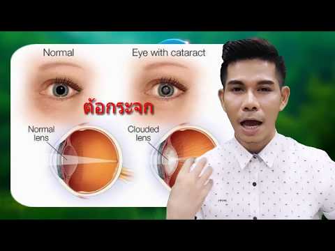 โรคสะเก็ดเงินและอาการคัน โรคสะเก็ดเงินที่ vylichit