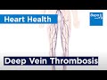 How Deep Vein Thrombosis DVT Forms