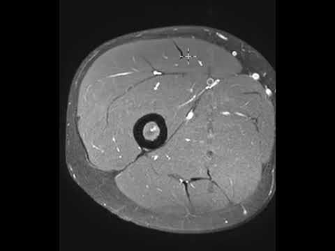 Rectus femoris muscle tear involving the indirect head