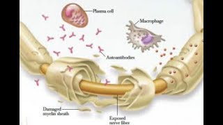 Demyelinating Neuropathy; group of peripheral nerve disorders Affecting myelin sheath