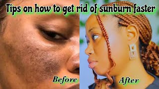 HOW TO GET RID OF SUNBURN ON THE FACE REALLY FAST| SUNBURN TREATMENT FOR DARK SKIN| HOME REMEDIES