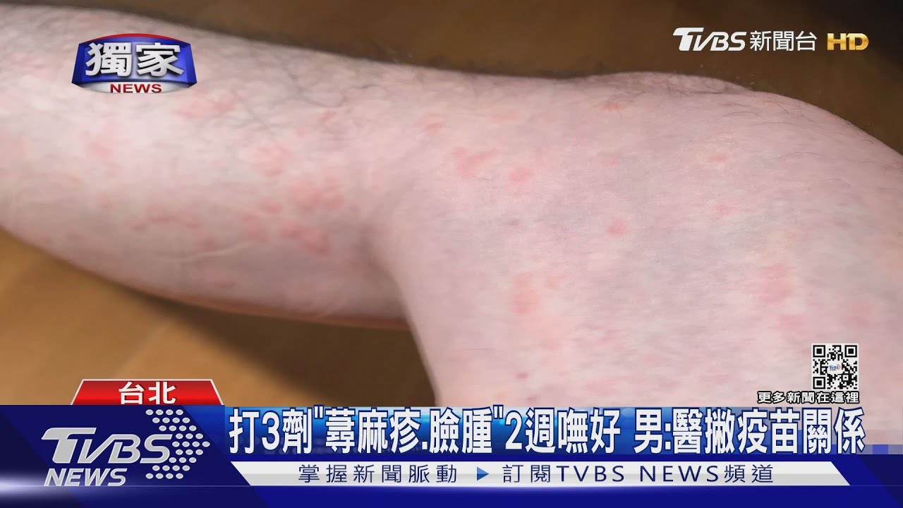 打3劑「蕁麻疹、臉腫」2週嘸好 男:醫撇疫苗關係