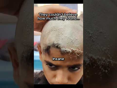 Going Bald for Dandruff ❄️⚠️