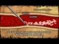 AIVL Vein Care Guide Vein Collapse Animation