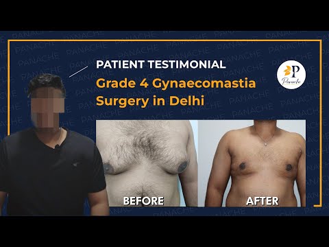 Gynecomastia Patient Story