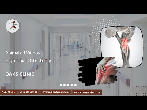 Animated High Tibial Osteotomy Surgery (HTO) | Knee Surgery | Dr. Amyn Rajani | Oaks Clinic