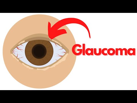 What is Glaucoma? Symptoms and Treatment Explained with Animations