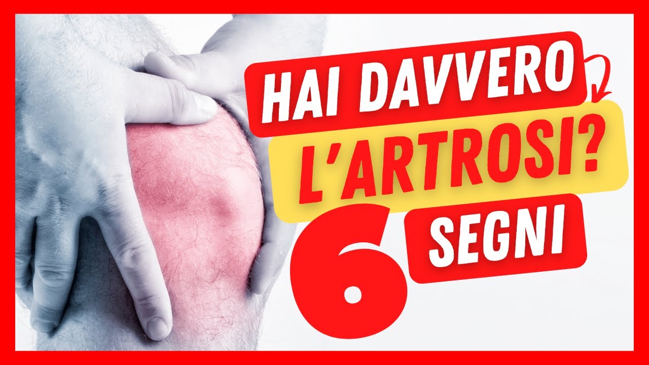 Watch Now Artrosi al GINOCCHIO: come riconoscerla | I 6 SEGNI e SINTOMI a cui devi fare caso❗ Artrosi al GINOCCHIO: come riconoscerla | I 6 SEGNI e SINTOMI a cui devi fare caso❗