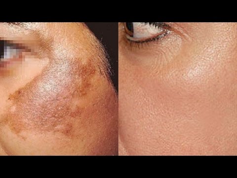 How To Use Potato To Treat Skin Pigmentation, Dark Spots, Acne Scars Easily At Home | Home Remedies