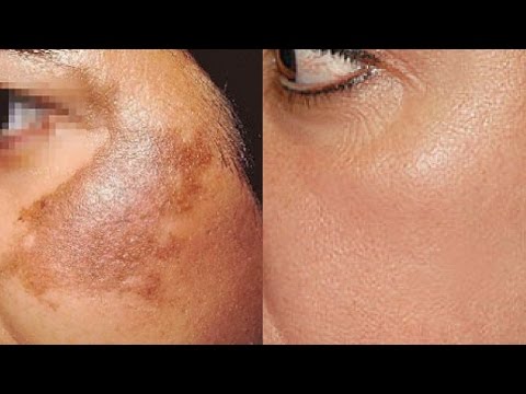 La vitamina E da pigmentary nota su risposte di faccia Pigmentazione irregolare di pelle a bambini