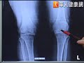 「針」夠力！玻尿酸注射緩解關節疼痛