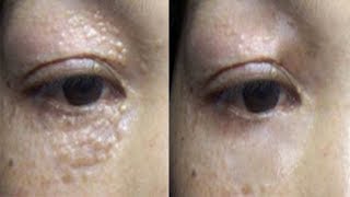 Unbelievable! How I Remove All Milia and White Bumps Under Eyes at Home | Milia Treatment