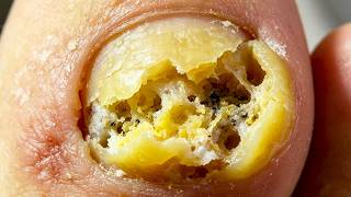 Thick Calluses On One Side Of The Toes Are Gently Smoothed Out【Xue Yidao】