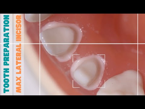 Tooth Preparation For A Crown - Maxillary Lateral Incisor 