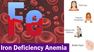 Iron Deficiency Anemia ( Clear & Complete Overview )