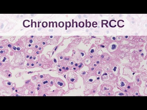 Chromophobe Renal Cell Carcinoma