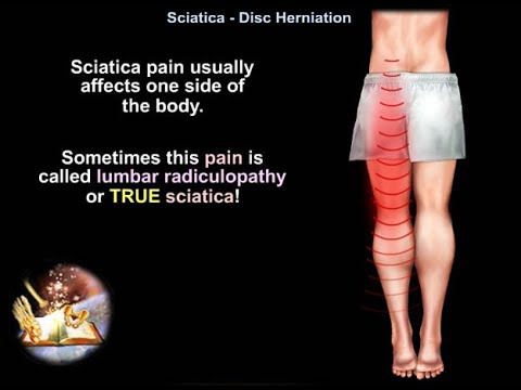 Sciatica Disc Herniation - Dr. Nabil Ebraheim