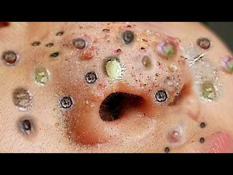 Blackhead Pop