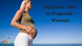Varicose Vein during Pregnancy