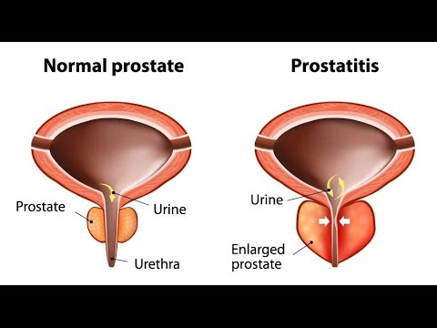 prostatitis és rák