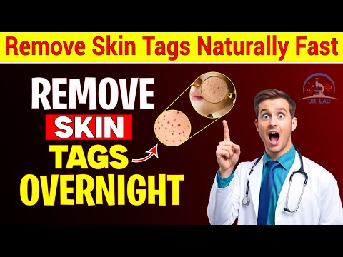 How To Remove Skin Tags And Warts Overnight   Fast, Easy & Natural Home Remedies!