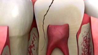 Dentist - Cracked Tooth Crown Procedure